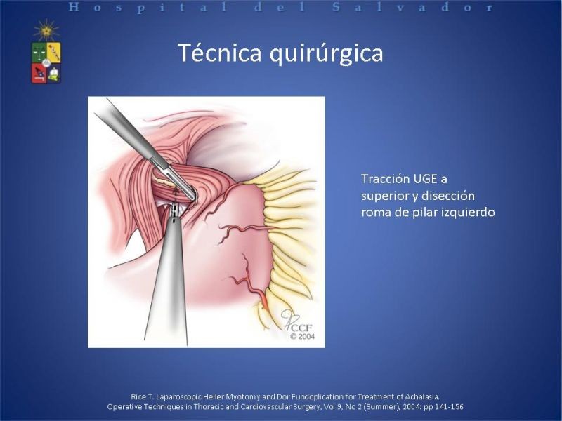 Diapositiva 18 de Manejo laparoscópico de la Acalasia