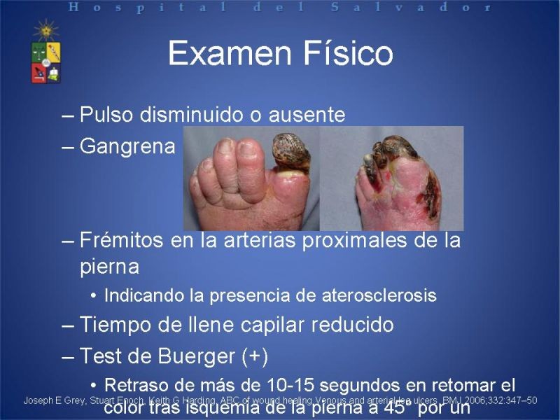 Diapositiva 19 de Úlceras de EEII