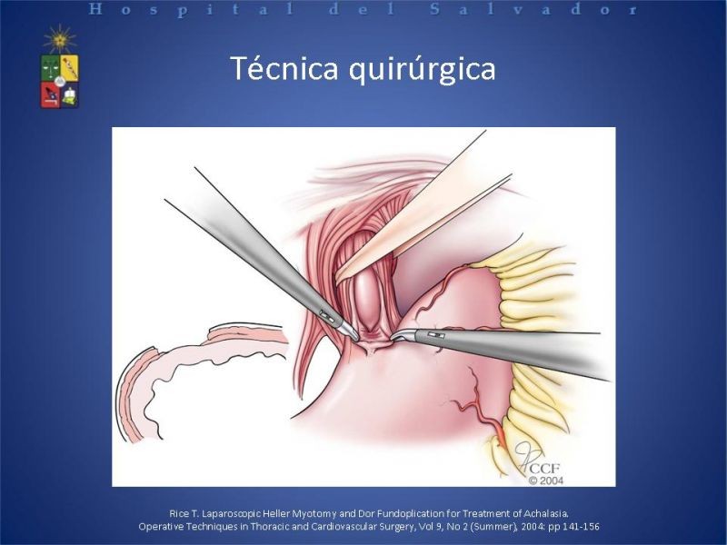 Diapositiva 20 de Manejo laparoscópico de la Acalasia