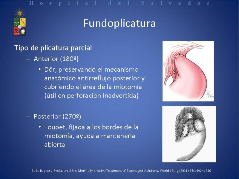 Diapositiva 12 de Manejo laparoscópico de la Acalasia