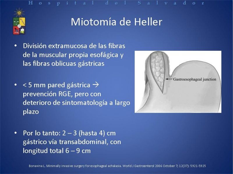 Diapositiva 9 de Manejo laparoscópico de la Acalasia