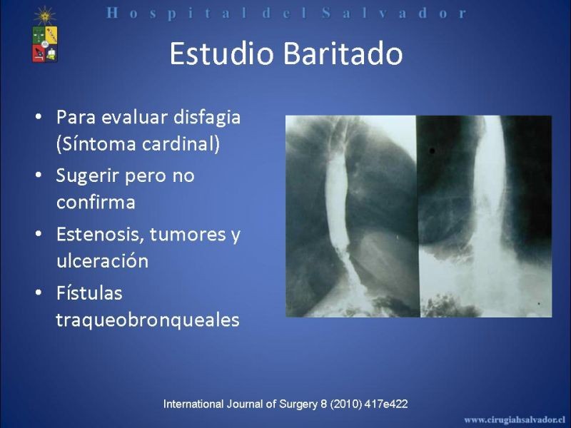 Diapositiva 20 de Cáncer de Esófago: Diagnóstico y etapificación