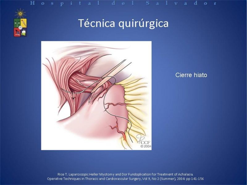 Diapositiva 21 de Manejo laparoscópico de la Acalasia