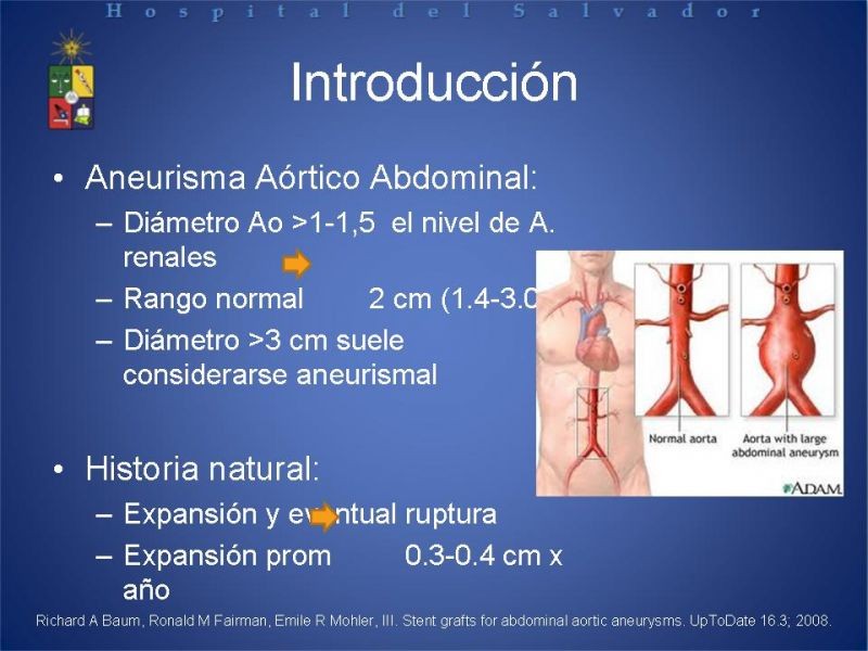Diapositiva 1 de Manejo Endovascular del AAA (EVAR)