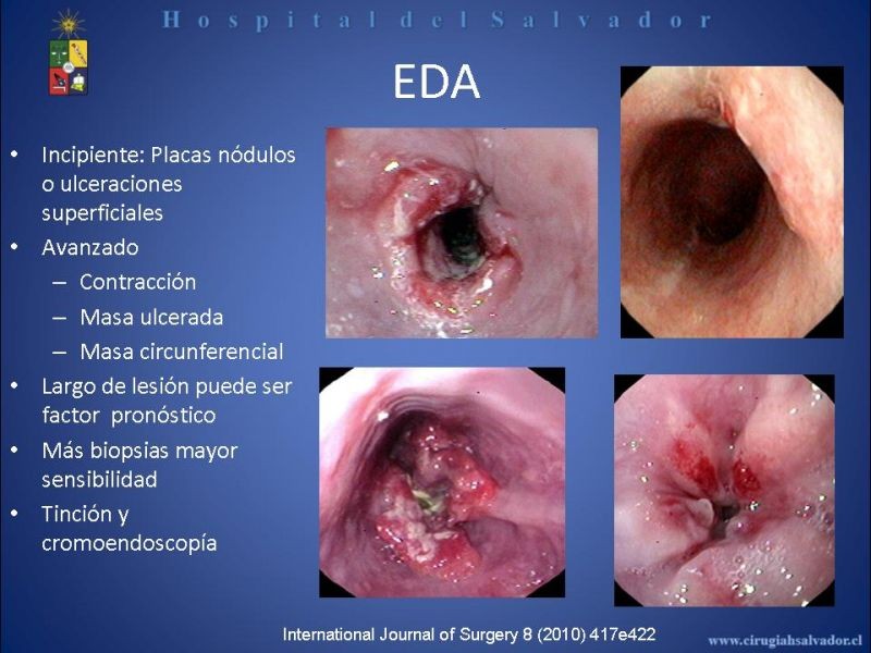 Diapositiva 22 de Cáncer de Esófago: Diagnóstico y etapificación