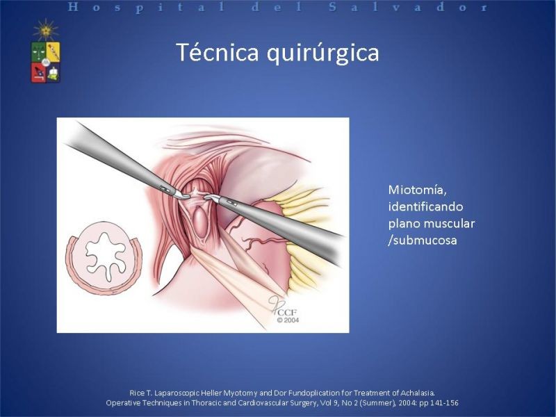 Diapositiva 19 de Manejo laparoscópico de la Acalasia