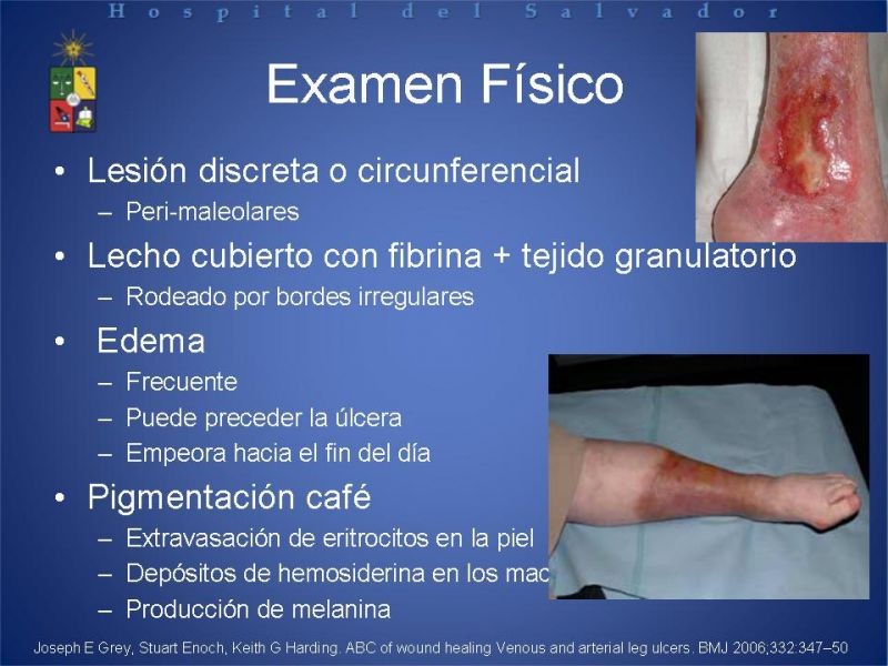 Diapositiva 5 de Úlceras de EEII