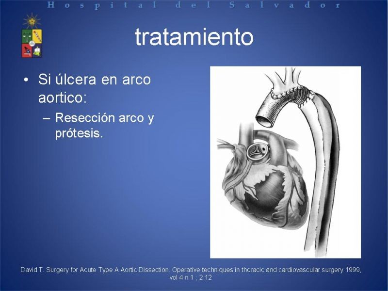 Diapositiva 24 de Disección Aortica tipo A