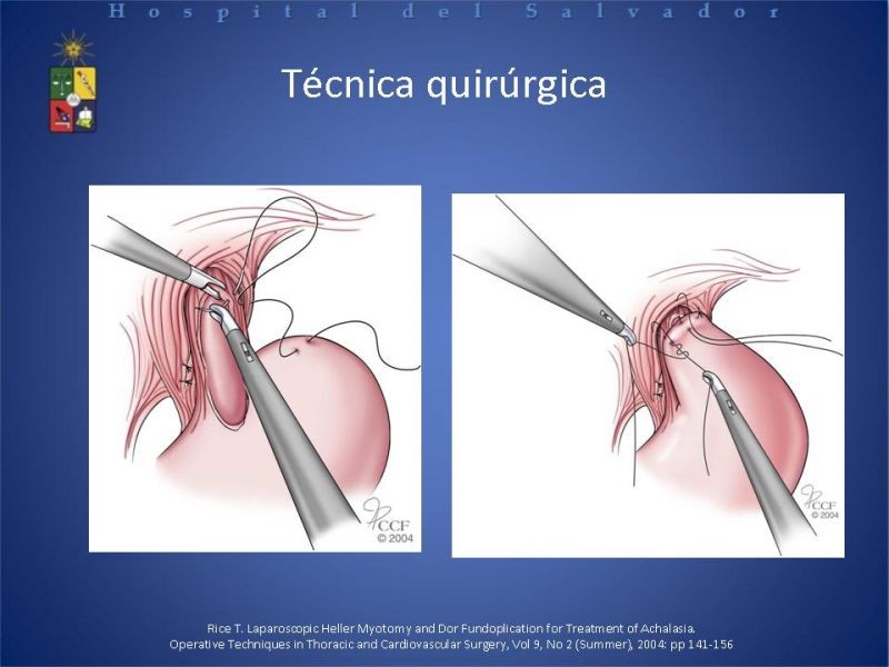 Diapositiva 22 de Manejo laparoscópico de la Acalasia