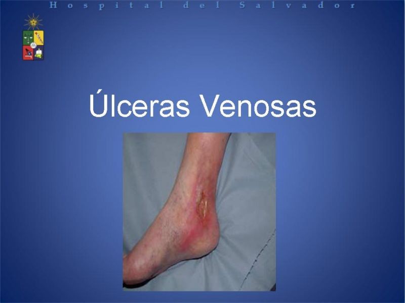 Diapositiva 1 de Úlceras de EEII