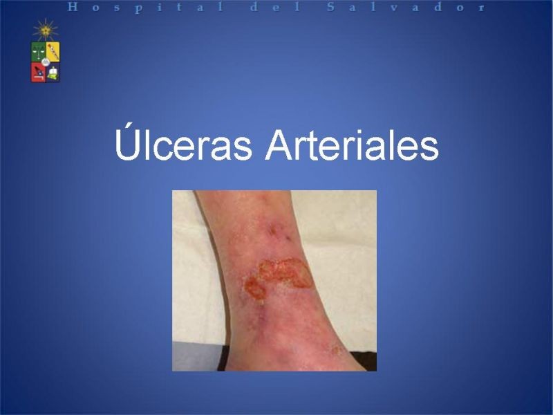 Diapositiva 15 de Úlceras de EEII