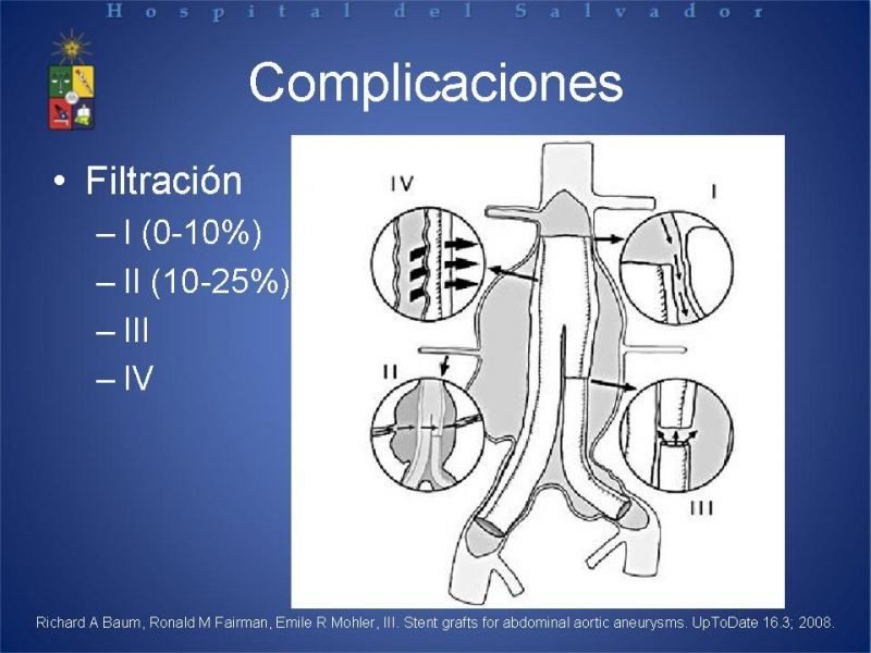 Diapositiva 20 de Manejo Endovascular del AAA (EVAR)