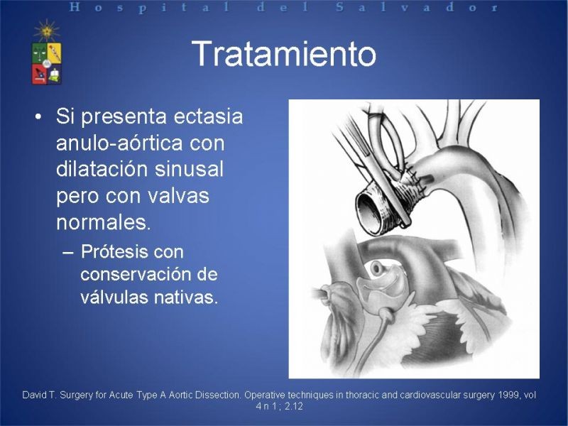 Diapositiva 25 de Disección Aortica tipo A