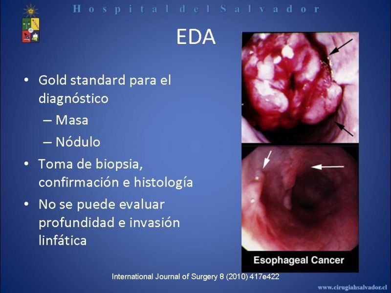 Diapositiva 21 de Cáncer de Esófago: Diagnóstico y etapificación