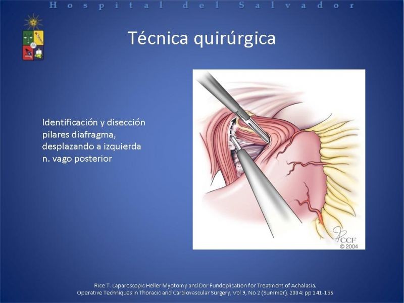 Diapositiva 17 de Manejo laparoscópico de la Acalasia