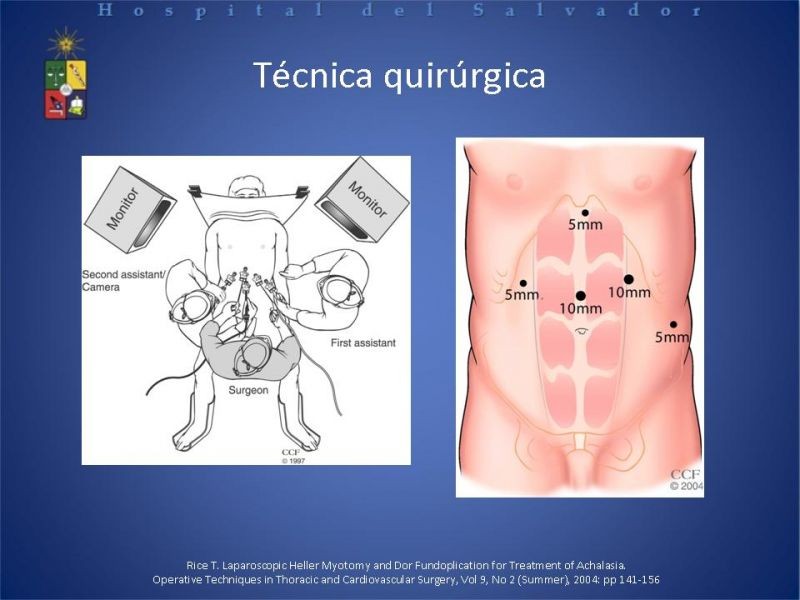 Diapositiva 15 de Manejo laparoscópico de la Acalasia