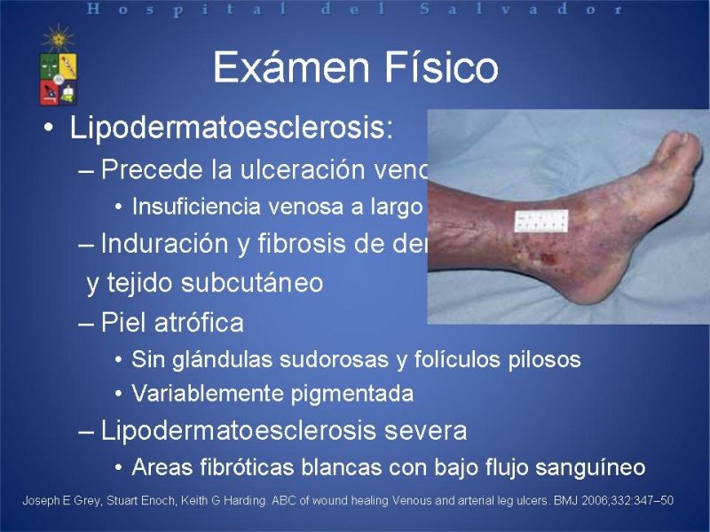 Diapositiva 6 de Úlceras de EEII