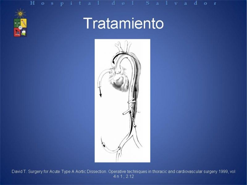 Diapositiva 22 de Disección Aortica tipo A