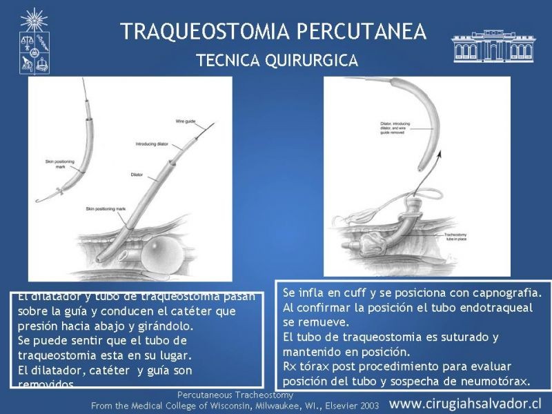 Diapositiva 25 de Traqueostomía