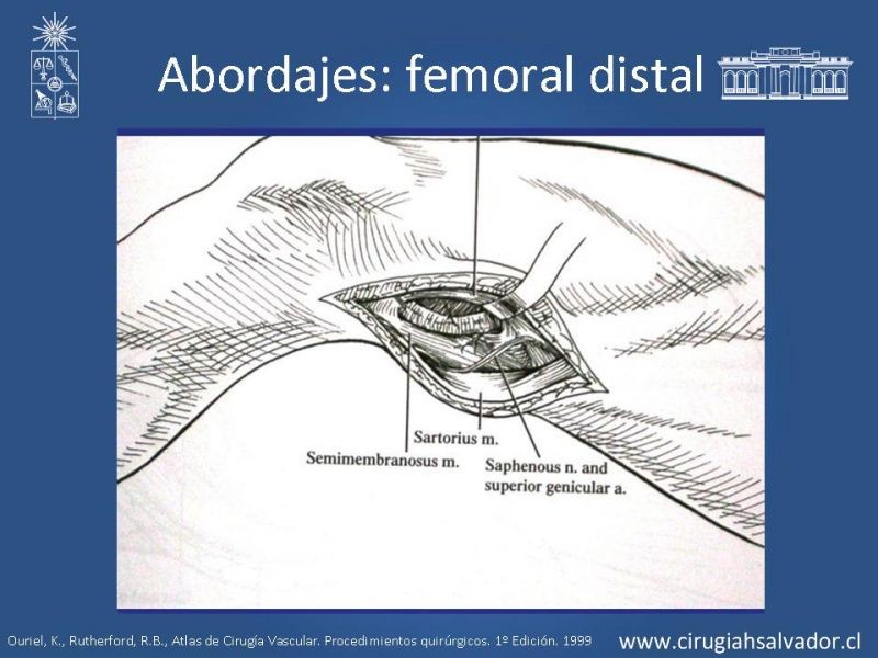 Diapositiva 17 de Manejo quirúrgico de la enfermedad arterial infrainguinal: Accesos 