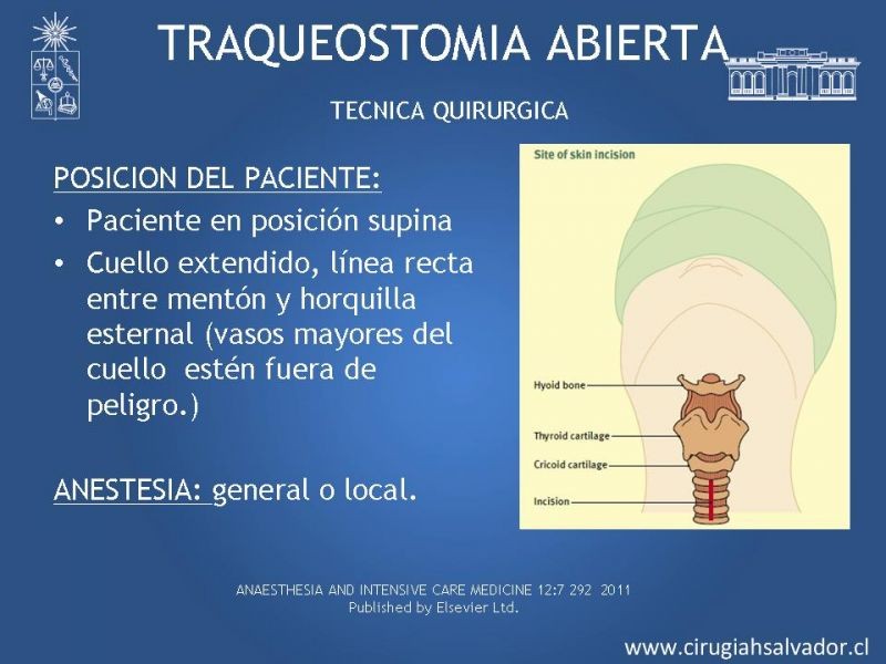 Diapositiva 12 de Traqueostomía