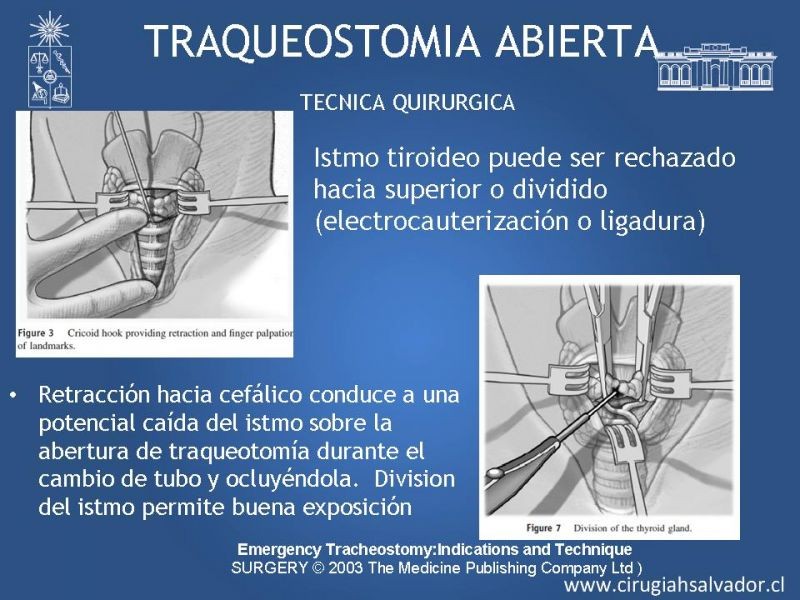 Diapositiva 15 de Traqueostomía