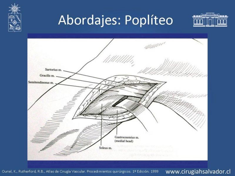 Diapositiva 21 de Manejo quirúrgico de la enfermedad arterial infrainguinal: Accesos 