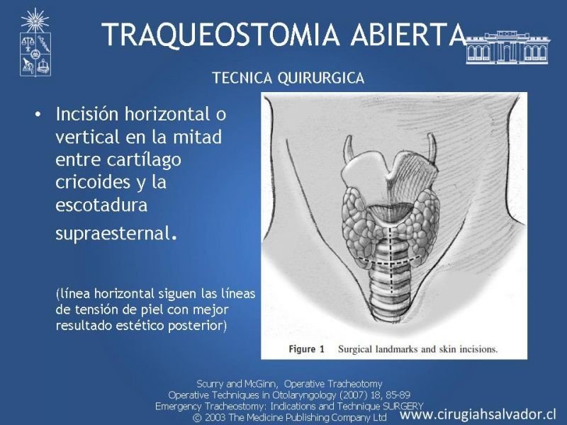 Diapositiva 13 de Traqueostomía