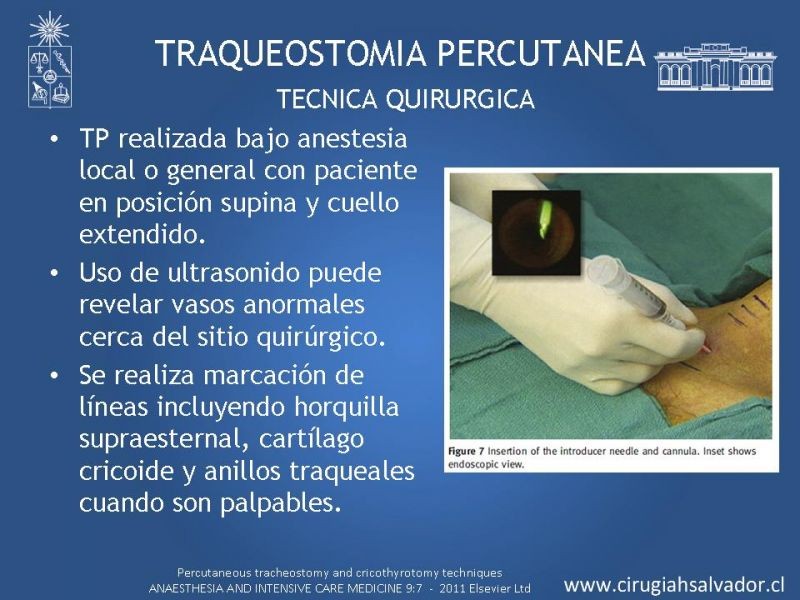Diapositiva 22 de Traqueostomía