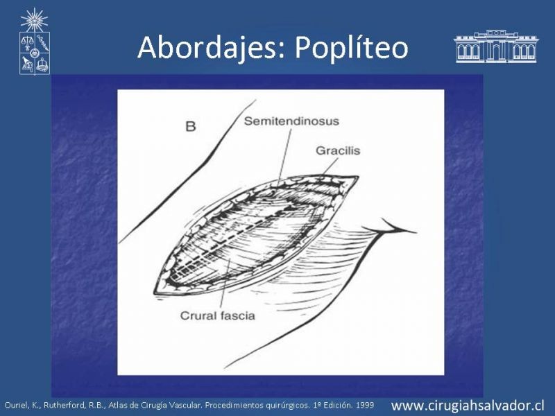 Diapositiva 20 de Manejo quirúrgico de la enfermedad arterial infrainguinal: Accesos 
