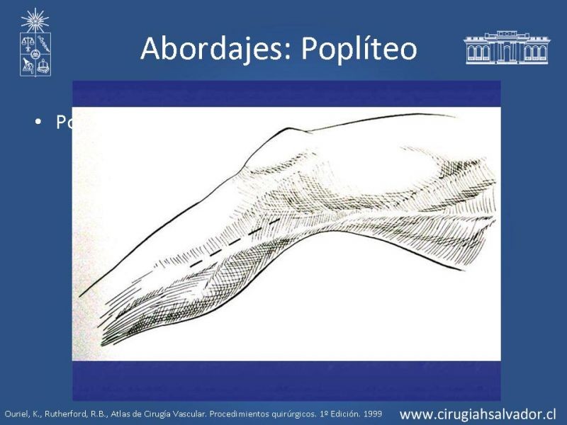 Diapositiva 19 de Manejo quirúrgico de la enfermedad arterial infrainguinal: Accesos 