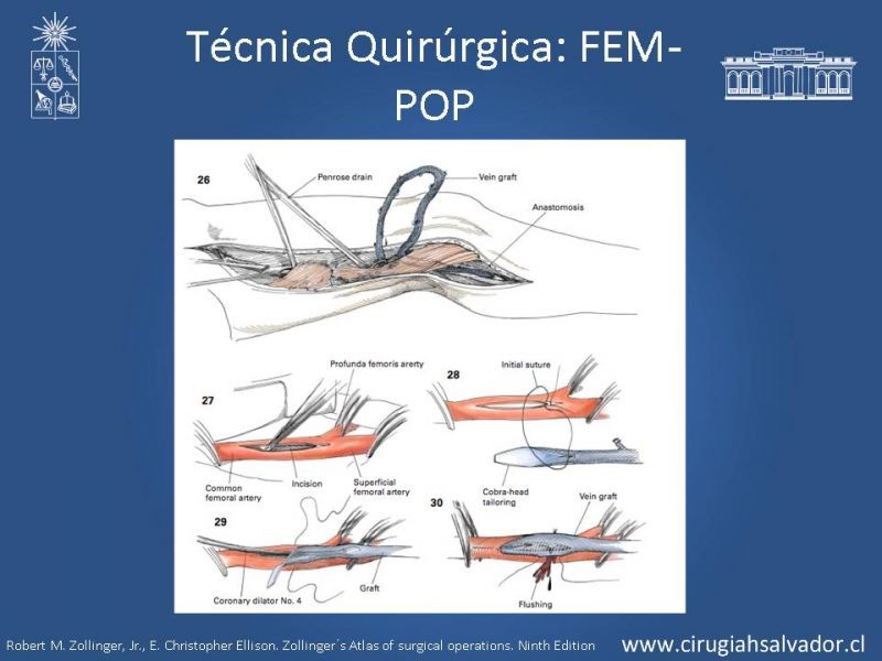 Diapositiva 32 de Manejo quirúrgico de la enfermedad arterial infrainguinal: Accesos 