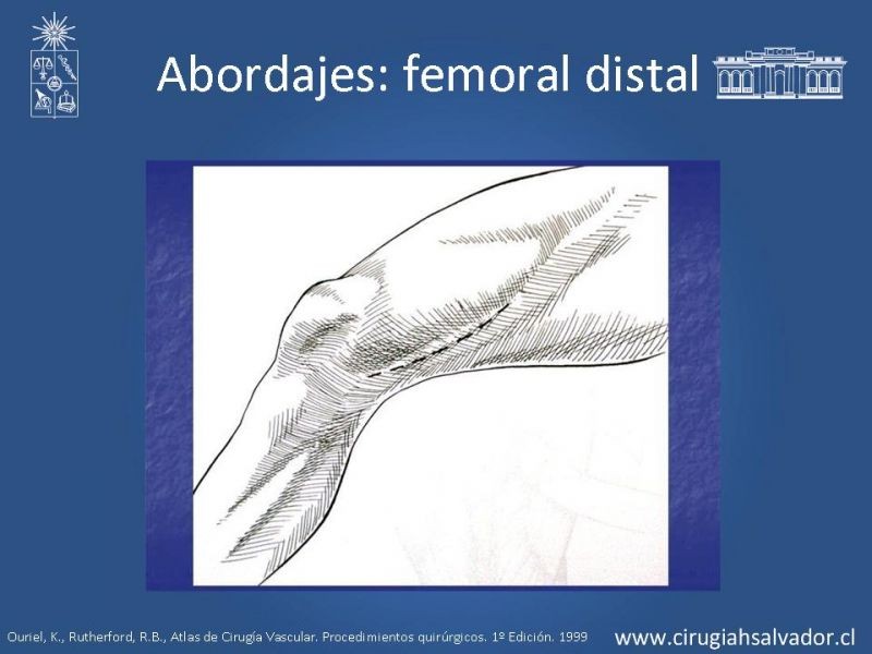 Diapositiva 16 de Manejo quirúrgico de la enfermedad arterial infrainguinal: Accesos 