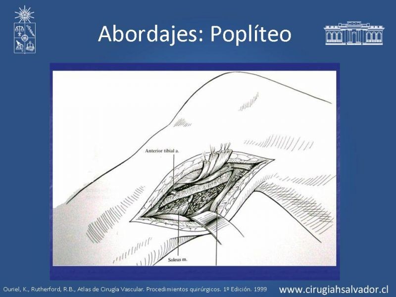 Diapositiva 23 de Manejo quirúrgico de la enfermedad arterial infrainguinal: Accesos 