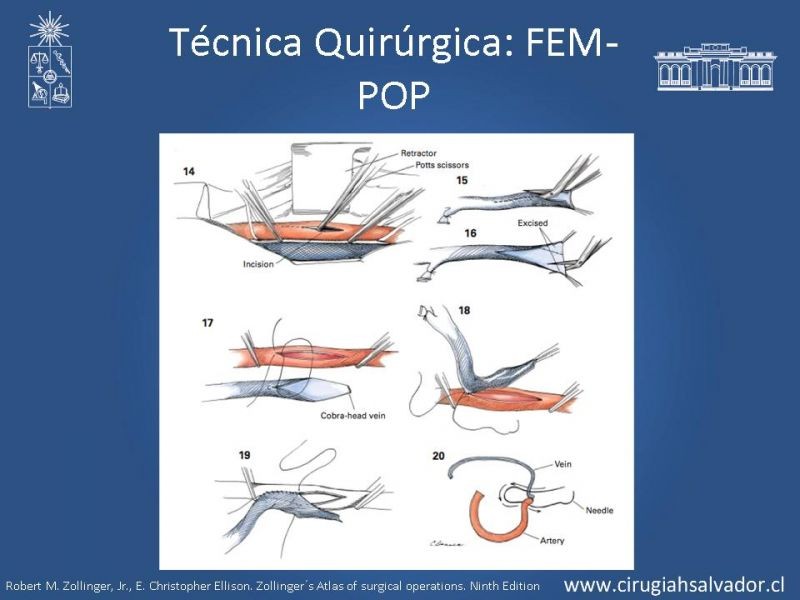 Diapositiva 29 de Manejo quirúrgico de la enfermedad arterial infrainguinal: Accesos 