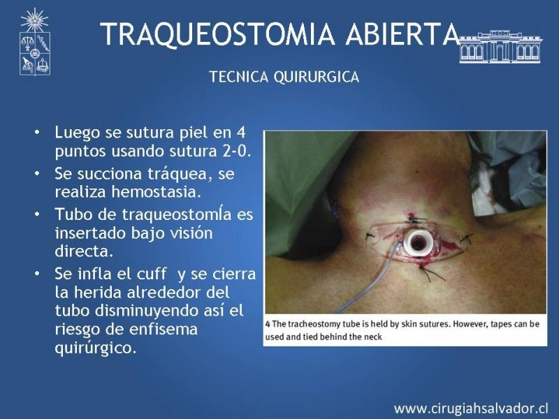 Diapositiva 19 de Traqueostomía