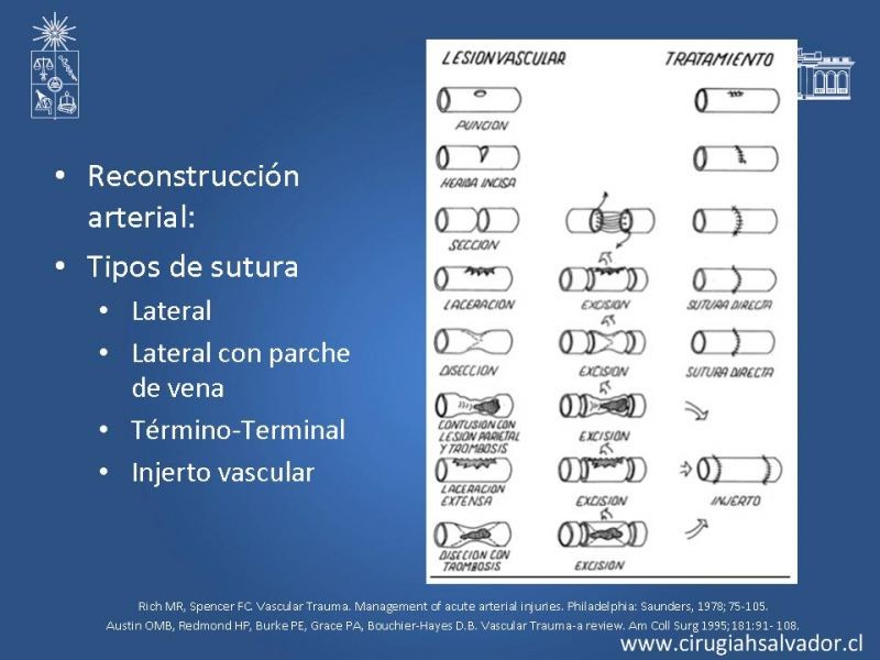 Diapositiva 20 de Trauma vascular periférico