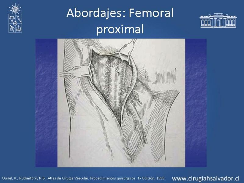 Diapositiva 14 de Manejo quirúrgico de la enfermedad arterial infrainguinal: Accesos 