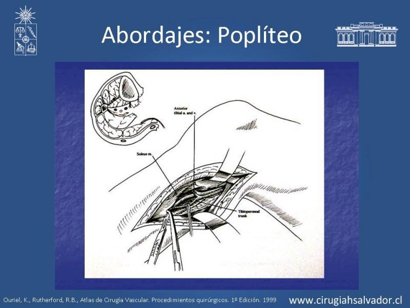Diapositiva 24 de Manejo quirúrgico de la enfermedad arterial infrainguinal: Accesos 
