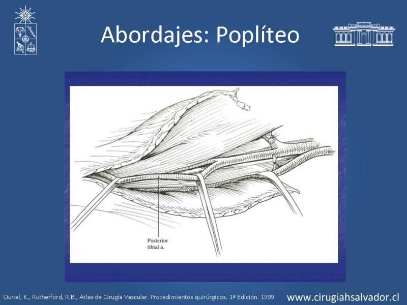 Diapositiva 25 de Manejo quirúrgico de la enfermedad arterial infrainguinal: Accesos 