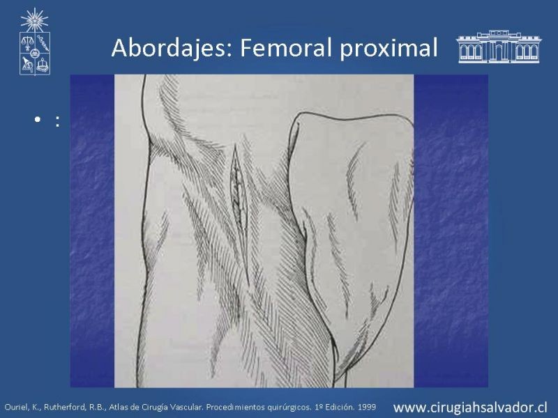 Diapositiva 13 de Manejo quirúrgico de la enfermedad arterial infrainguinal: Accesos 