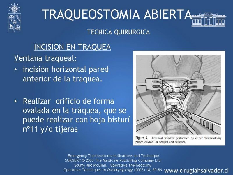 Diapositiva 16 de Traqueostomía