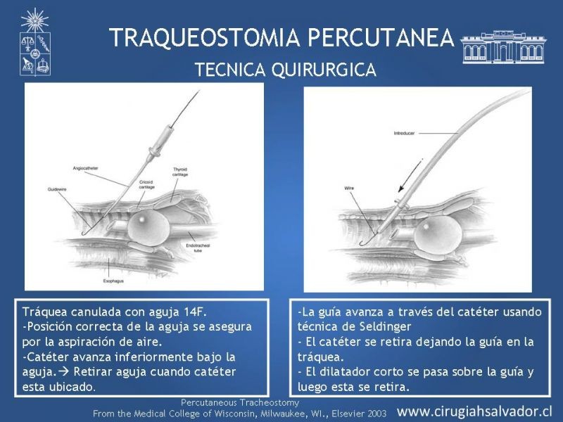 Diapositiva 24 de Traqueostomía