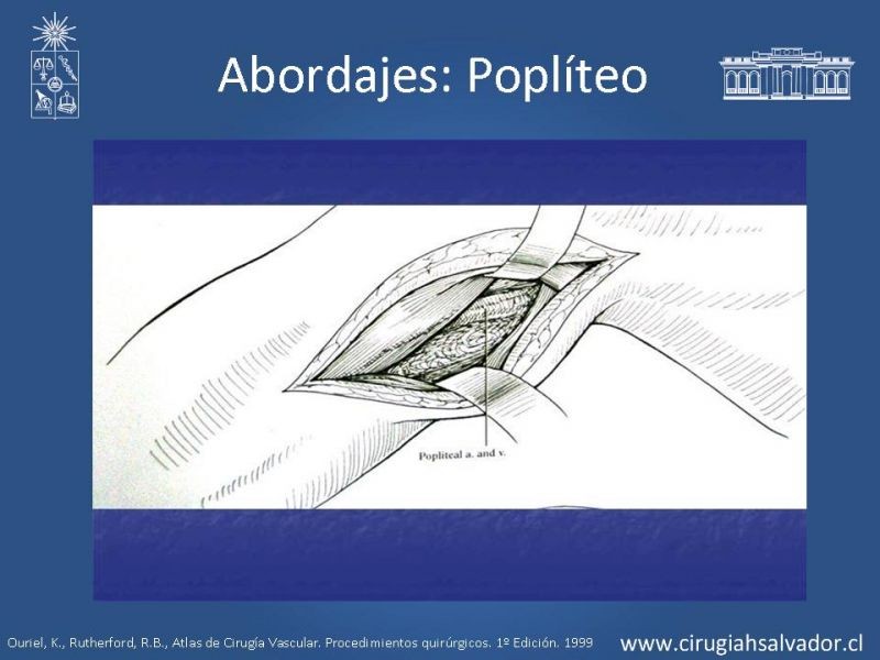 Diapositiva 22 de Manejo quirúrgico de la enfermedad arterial infrainguinal: Accesos 
