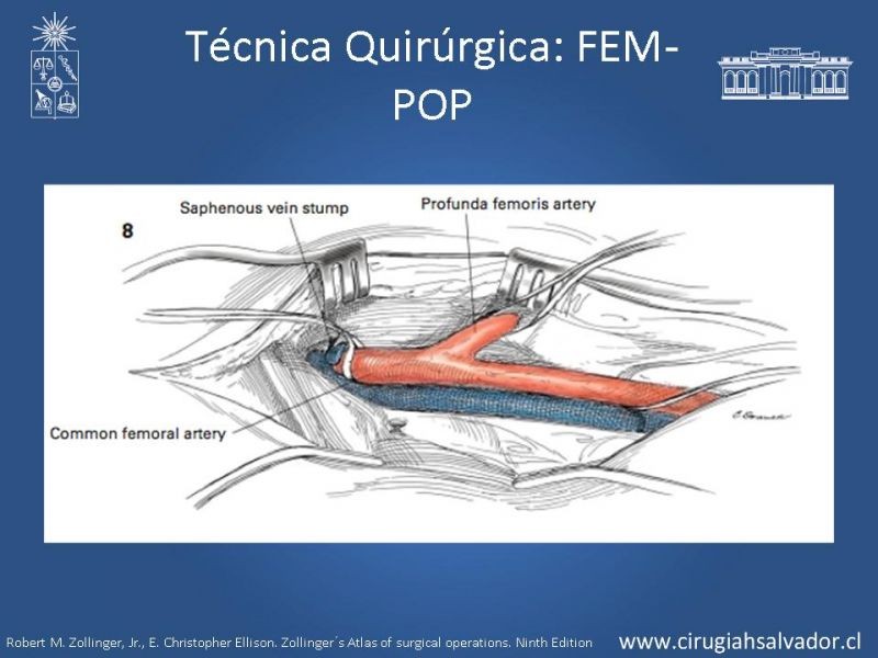 Diapositiva 27 de Manejo quirúrgico de la enfermedad arterial infrainguinal: Accesos 