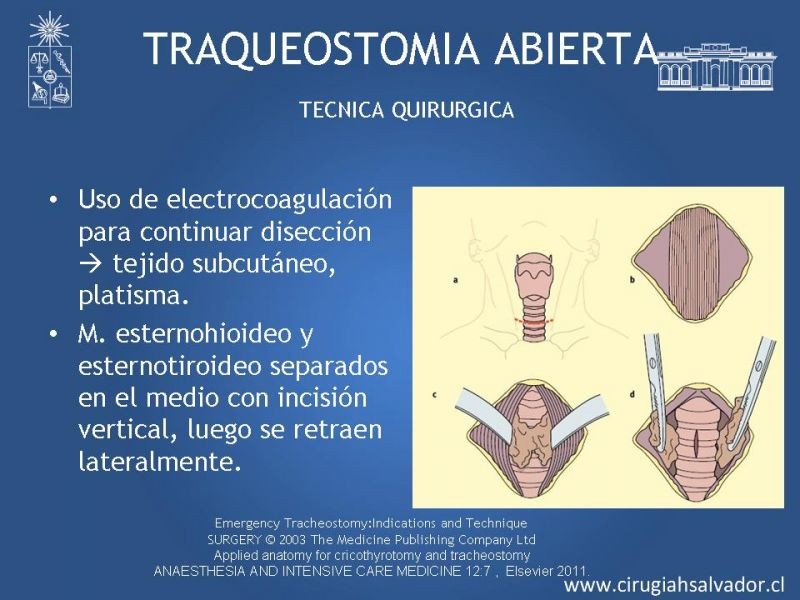 Diapositiva 14 de Traqueostomía