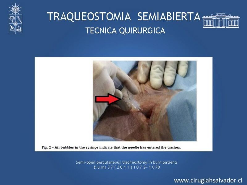 Diapositiva 30 de Traqueostomía