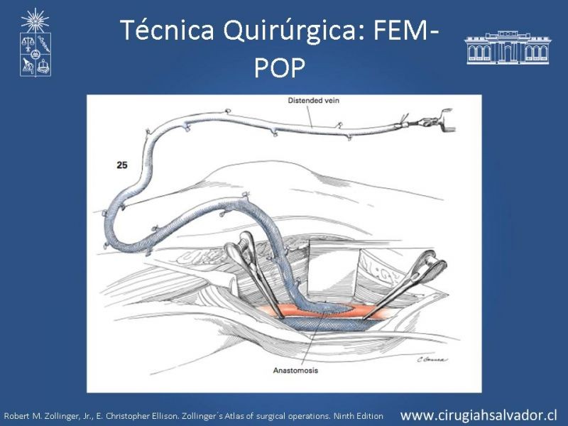 Diapositiva 31 de Manejo quirúrgico de la enfermedad arterial infrainguinal: Accesos 