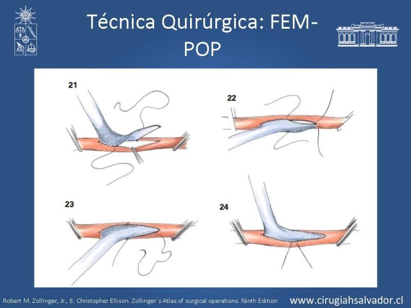 Diapositiva 30 de Manejo quirúrgico de la enfermedad arterial infrainguinal: Accesos 