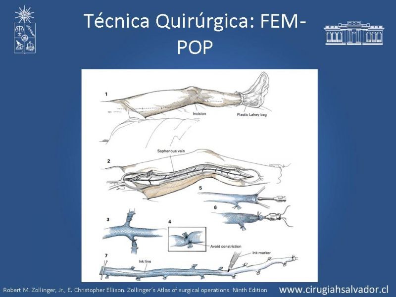 Diapositiva 26 de Manejo quirúrgico de la enfermedad arterial infrainguinal: Accesos 